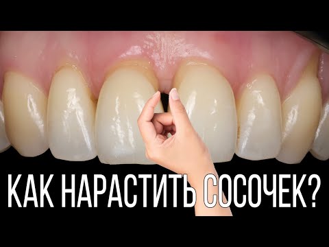 Видео: Восстановление межзубного сосочка - техника вывернутого сосочка / twisted papillae technique