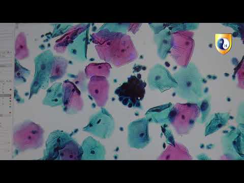 Видео: Дисплазия тяжелой степени HSIL. Цитологический практикум.