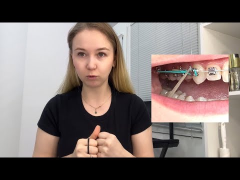 Видео: МИНИВИНТЫ. МОЙ ОПЫТ И ОШИБКИ. СНЯЛИ ВЕРХНИЕ БРЕКЕТЫ