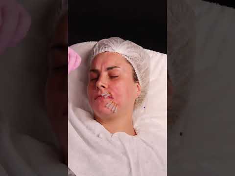 Видео: Имплантация мезонитей Twin Screw / Объемная пружинка