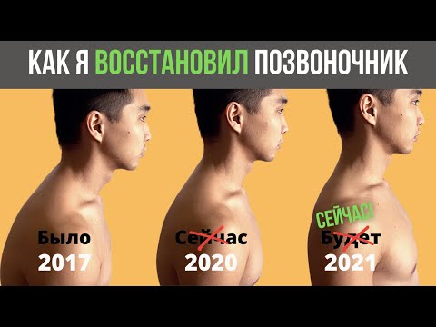 Видео: У меня был абсолютно кривой позвоночник ЧАСТЬ 3 | Кифоз, Лордоз, Сколиоз