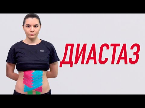 Видео: ▶️ ДИАСТАЗ. ТЕЙПИРОВАНИЕ ПРИ СРЕДНЕЙ И ЛЕГКОЙ СТЕПЕНИ | Валентин Гайт | Учебный центр BBALANCE