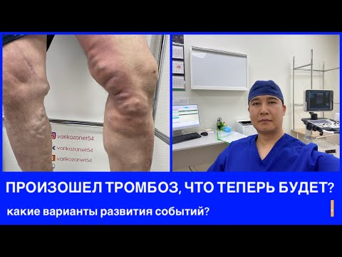 Видео: Тромбоз вен нижних конечностей: исходы