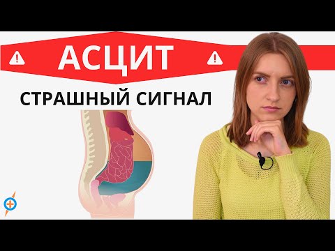 Видео: Какие болезни ведут к АСЦИТУ (водянке живота)? | Mednavigator.ru