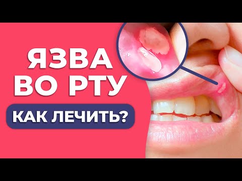 Видео: Как вылечить ЯЗВУ ВО РТУ? / Афта: причины появления