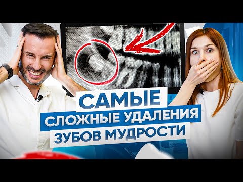 Видео: ТОП 3 самых сложных случаев удаления зубов мудрости