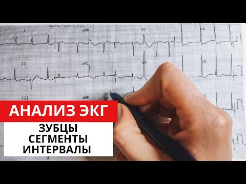 Видео: Алгоритм анализа ЭКГ. Характеристика зубцов, сегментов, интервалов.