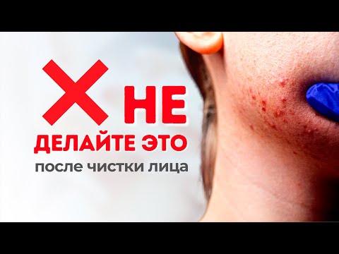 Видео: Чистка лица без воспалений и высыпаний: правила ухода за кожей лица после процедуры