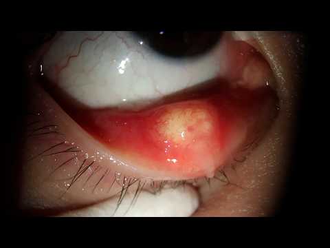 Видео: Марафон по удалению ячменя — 1 час, 2024-2025