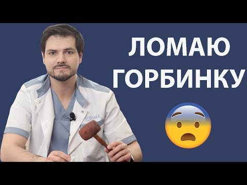 Видео: Как убрать горбинку на носу // Ринопластика // Нос с горбинкой