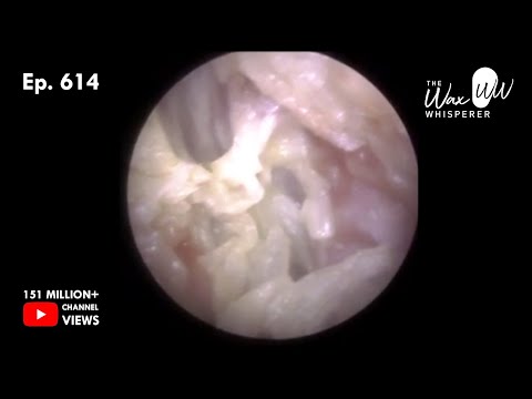 Видео: 614 - Тяжелая инфекция наружного уха. Микроаспирация