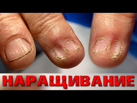 Видео: НОГТЯ НЕТ?!😨 Отпал..⚠️ ПРОТЕЗ из Кольца. Наращивание/ПРОТЕЗИРОВАНИЕ ногтя.ТРЕШ маникюр.