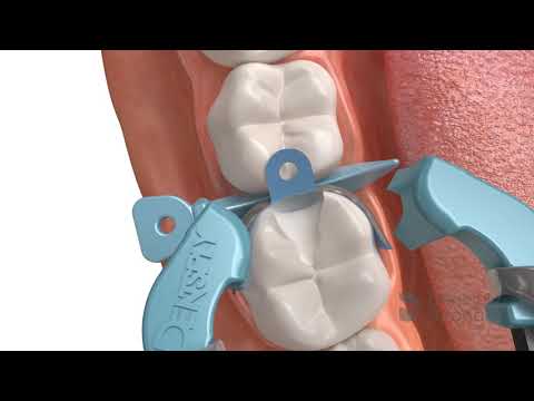 Видео: Матричная система PalodentV3_как пользоваться