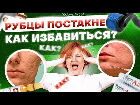 Видео: Рубцы постакне, рубцы после прыщей. Как от них избавиться?