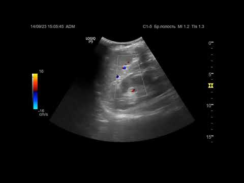 Видео: Ультразвуковая диагностика (УЗИ). Доктор Иогансен. Видеопримеры. Выпуск 33. Методика УЗИ селезенки.