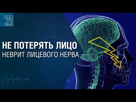 Видео: Не потерять лицо. Неврит лицевого нерва. На здоровье 01.06.2024