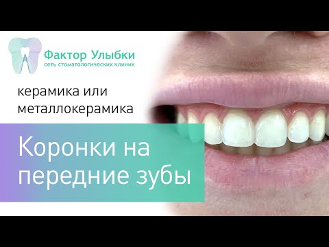 Видео: Коронки на передние зубы - какие поставить?