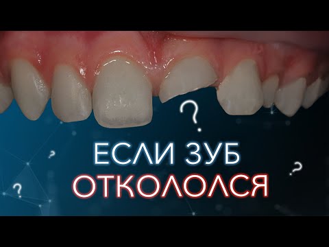 Видео: Откололся зуб. Что с этим делать?