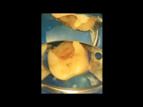 Видео: 2021-03-29 Наложение девитализирующей пасты!  Да-да, именно, не опечатка - правильно прочитали