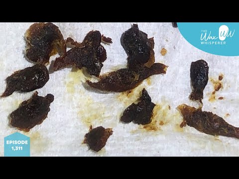 Видео: 1311 — Уши, полные ушной серы, очищены