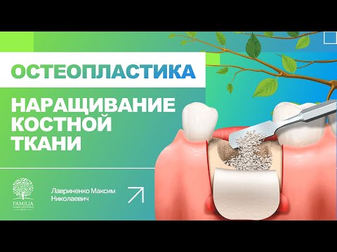 Видео: 👆 Остеопластика - наращивание костной ткани