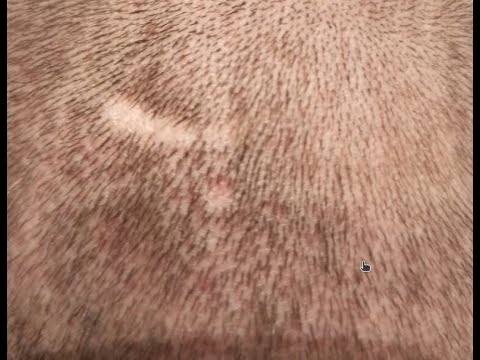 Видео: Опасно! Пересадка волос в Турции у Красавчик и Bellus Сlinic (Беллус клиник).