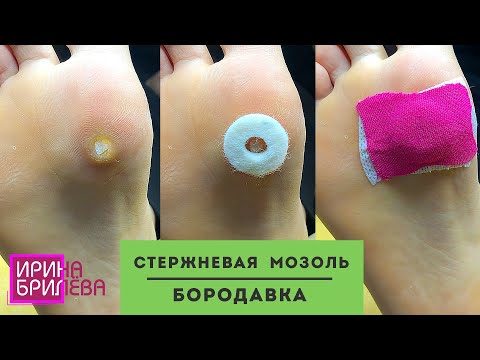 Видео: Стержневая мозоль ИЛИ бородавка? 🌸 ЧТО БЫВАЕТ, если заниматься самолечением 🌸 Ирина Брилёва