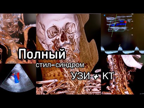 Видео: Полный стил-синдром. Диагностика на УЗИ и КТ. Болезнь Такаясу.