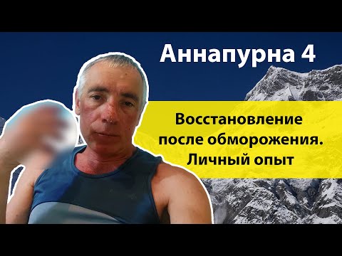 Видео: Моя битва с обморожением. Путь к выздоровлению.