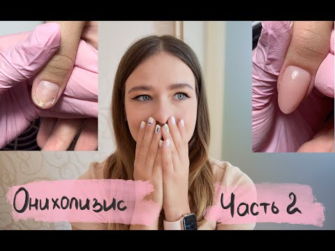 Видео: Онихолизис часть 2 | Как отрос ноготок | Протезирование онихолизиса