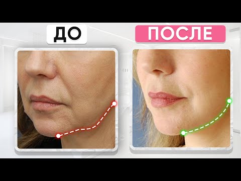 Видео: Брыли УЙДУТ НАВСЕГДА за 20 МИНУТ! / Эффективные УПРАЖНЕНИЯ от брылей в ДОМАШНИХ УСЛОВИЯХ!