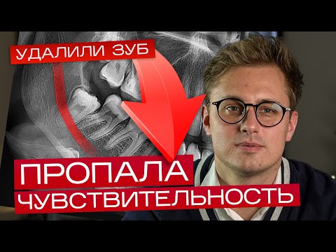 Видео: Парестезия тройничного нерва при удалении зубов мудрости. Как этого избежать?