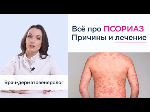 Видео: ПСОРИАЗ - причины, подробно о лечении, признаки и симптомы псориаза