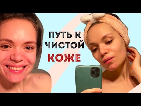 Видео: АКНЕ: ДО И ПОСЛЕ 💫 Моя история длиной в 13 лет