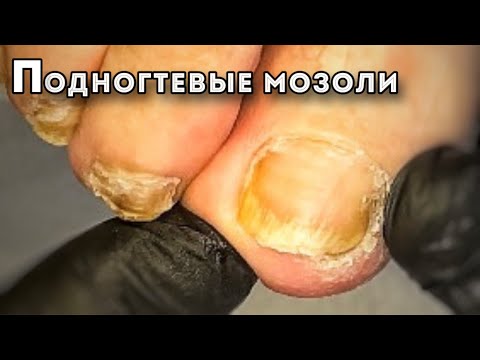 Видео: Вычищаю боковые пазухи от мозолей