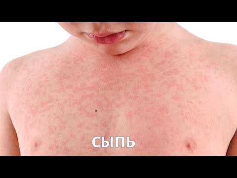 Видео: Сыпь. Фактор роста