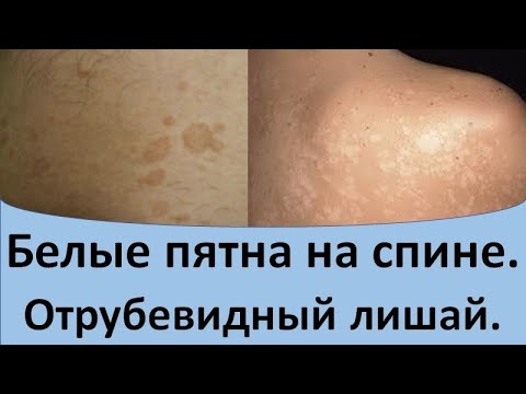 Видео: Белые пятна на спине.  Отрубевидный лишай.