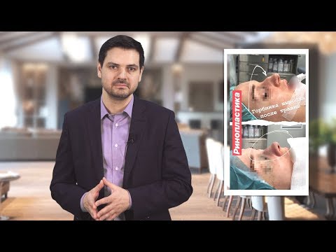 Видео: Ринопластика//снова выросла горбинка