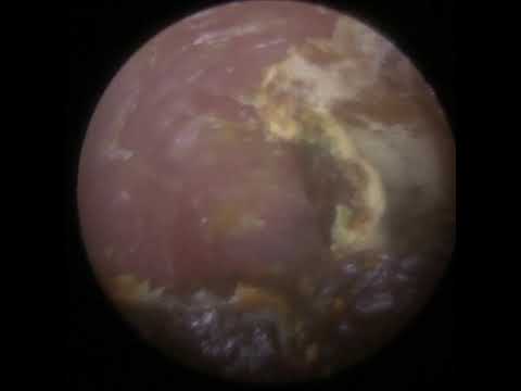 Видео: 843 - Стойкая грибковая инфекция уха и отслоение омертвевшей кожи