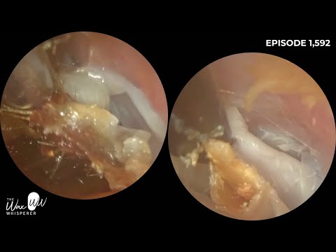 Видео: 1,592 - Удаление вулканической омертвевшей кожи