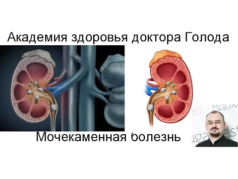 Видео: Мочекаменная болезнь в почках.