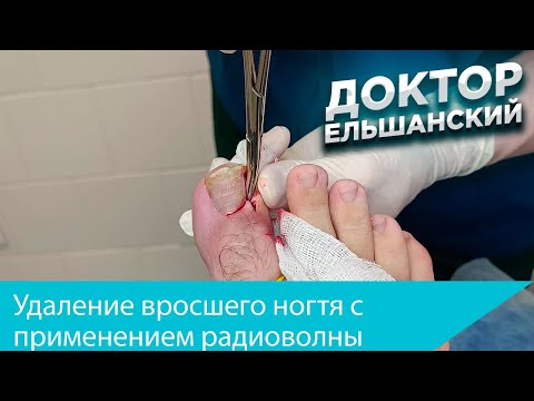 Видео: Удаление вросшего ногтя с применением радиоволны
