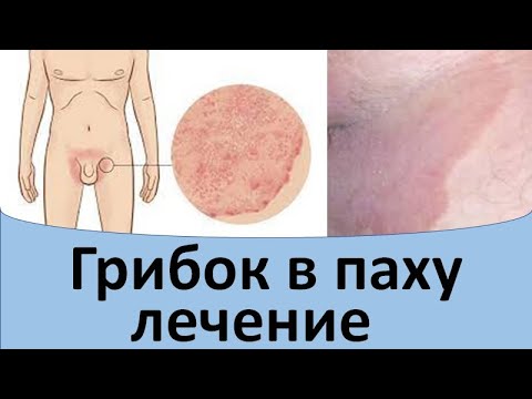 Видео: Грибок в паху лечение