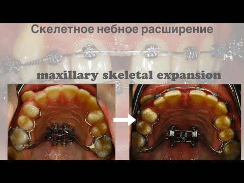 Видео: MSE/MARPE. Скелетное небное расширение с опорой на микроимпланты