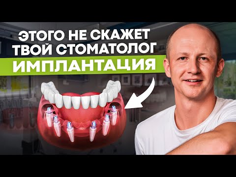 Видео: Подготовка к ТОТАЛЬНОЙ ИМПЛАНТАЦИИ / Такого НЕ СКАЖЕТ твой стоматолог 