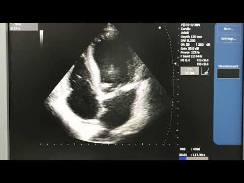 Видео: Инфекционный эндокардит аортального клапана