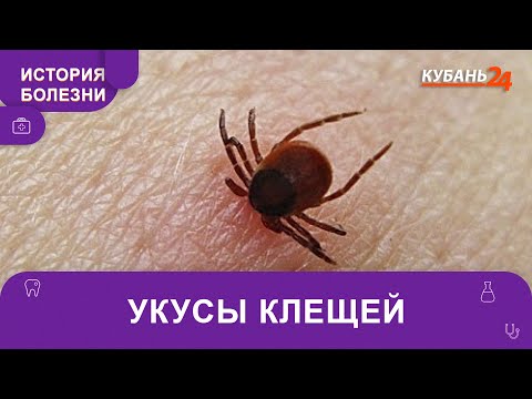 Видео: Укусы клещей | История болезни