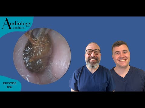 Видео: Набор для удаления ушной серы, включая глубокие ушные серные пробки - EP807