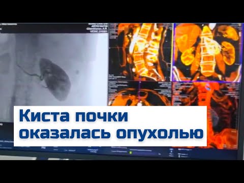 Видео: Опухоль почки или киста? Как поставить правильный диагноз