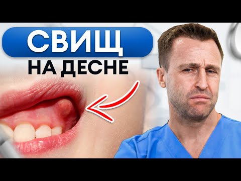Видео: Как опознать и вылечить СВИЩ на десне?